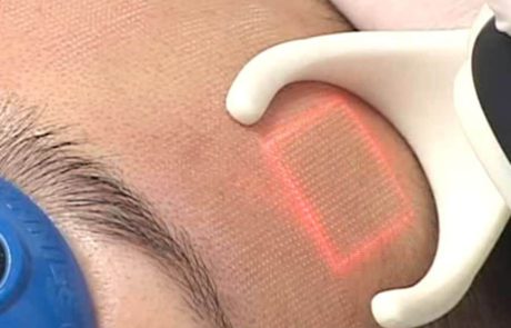 Laser beam shaping case study – Diffractive optical elements for fractional laser aesthetic treatments
