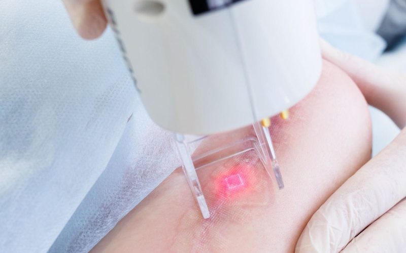 Diffractive optics case study – A special beam combining diffractive element for both guide laser and treatment laser wavelengths Diffractive optics case study - A special beam combining diffractive element for both guide laser and treatment laser wavelengths