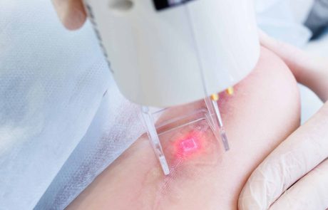 Enhancing Laser Medical Aesthetic Applications with Diffractive Optical Elements (DOEs)